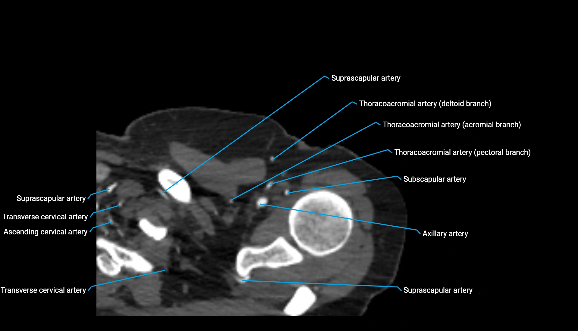 CTA upper limb axial cross sectional anatomy labelled image 329 (1).webp